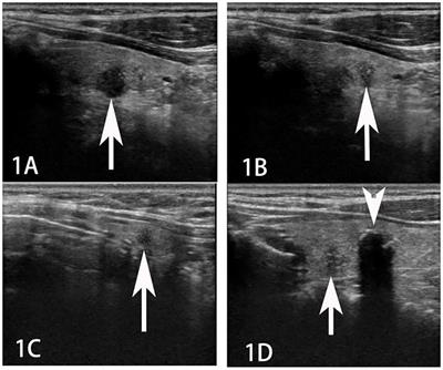 Case report: Rare presentation of double primary malignancies of the lung and thyroid: a difficult diagnosis